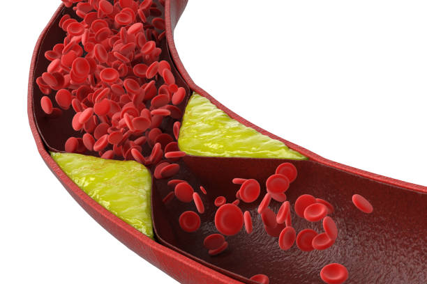 atherosclerosis with plaque in vessel stock photo