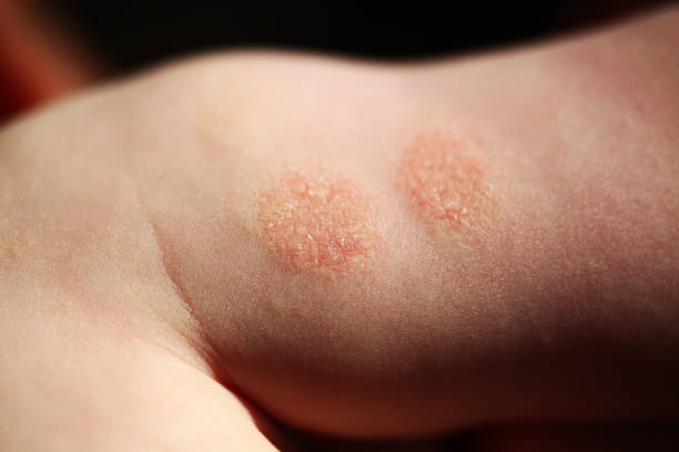 Atopic dermatitis in a child stock photo