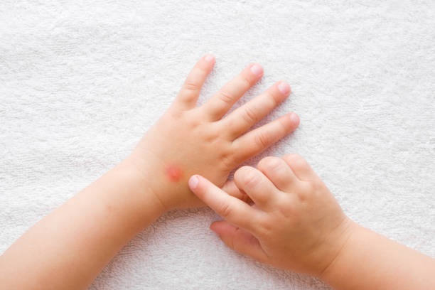 Baby girl finger pointing to itchy hand skin after mosquito bites on white towel background. Point of view shot. Closeup. Top down view. stock photo