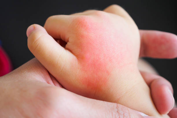mano de bebé con erupción cutánea y alergia con causa punto rojo por picadura de mosquito - enfermedad de la piel fotografías e imágenes de stock