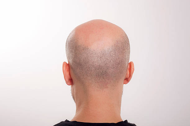 On back spot of head bald What Causes