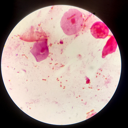 Red cells Bacteria cell Gram neagative bacilli with capsule pathogen.Sample sputum in Gram stain method.