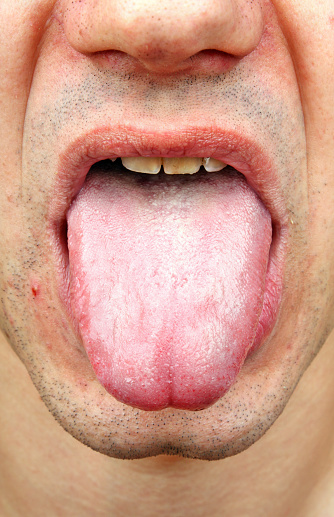 Bacterial Infection Disease Tongue Stock Photo - Download Image Now