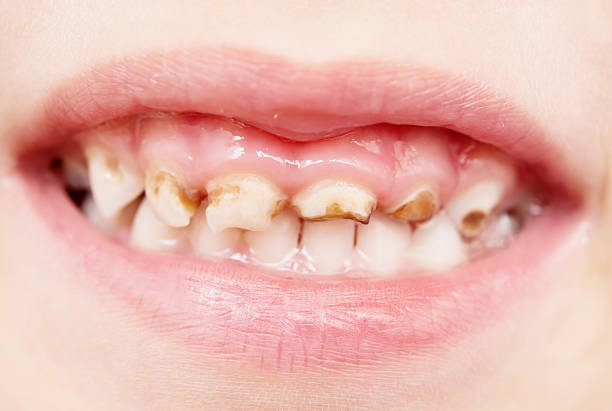 bad teeth close up of bad baby teeth rotten teeth in children stock pictures, royalty-free photos & images