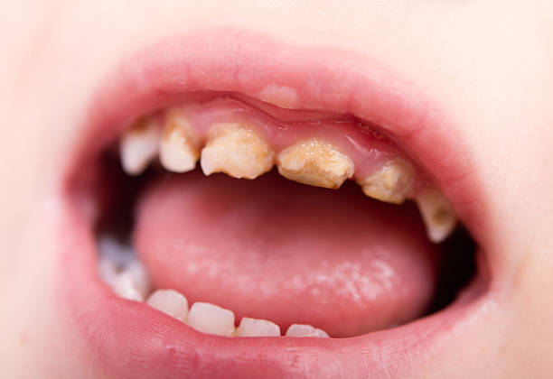 bad teeth baby bad teeth rotten teeth in children stock pictures, royalty-free photos & images