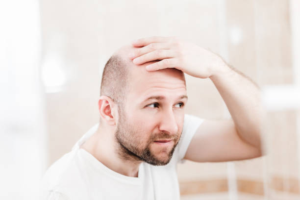Bald man looking mirror at head baldness and hair loss stock photo