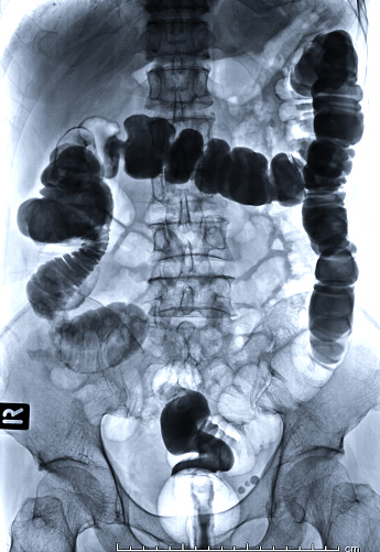 Barium Enema Image Front View Is A Rectal Injection Of 