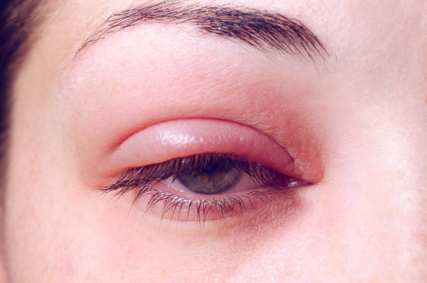 Barley infection on the eye stock photo