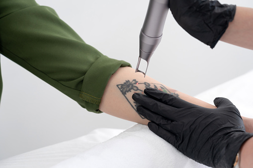Beautician using laser device to remove an unwanted tattoo from female arm. Concept of erasing tattoos as expensive procedure in a cosmetology clinic