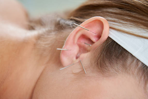 Beautiful woman relaxing on a bed having acupuncture treatment with needles in and around her ear. Alternative Therapy concept stock photo