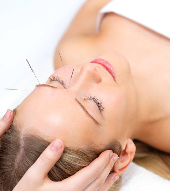 Beautiful young woman with eyes closed receiving acupuncture therapy  acupuncture stock pictures, royalty-free photos & images
