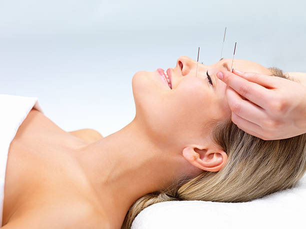 Beautiful young woman with eyes closed receiving Acupuncture therapy  acupuncture stock pictures, royalty-free photos & images