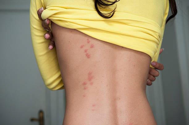 Bedbug bites in hotel room Bedbug bites are visible on the back of a woman standing in a hotel room chewing stock pictures, royalty-free photos & images