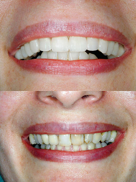 Best teeth whitening for crooked teeth