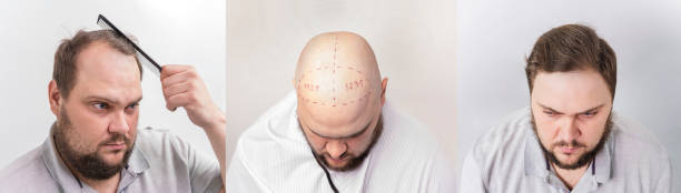 before and after bald head of a man. the process of hair transplantation on the head. treatment of baldness. stock photo