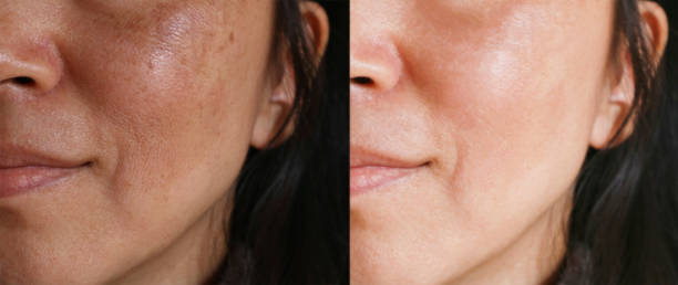 Before and after facial treatment concept. Face with melasma and brown spots and open pores. stock photo