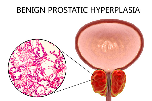 Prostate Hyperplasia és Cyst férfi prosztata