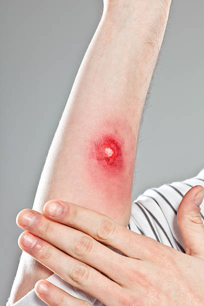 Best Infected Wound Stock Photos, Pictures & Royalty-Free ...