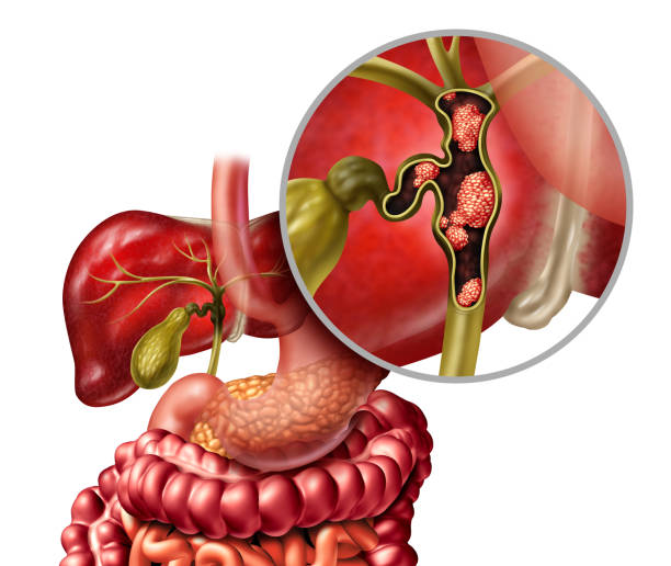 Bile Duct Cancer Bile duct cancer or cholangiocarcinoma with a gall bladder and liver as a disease of the digestive system representing a medical health care concept in human organ anatomy with 3D illustration elements. human digestive system photos stock pictures, royalty-free photos & images