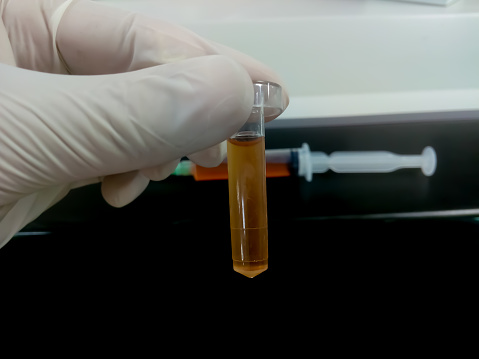 Biochemist hold Cerebrospinal fluid (CSF) sample, which is ready for biochemical test (Glucose, Protein, ADA). Closeup