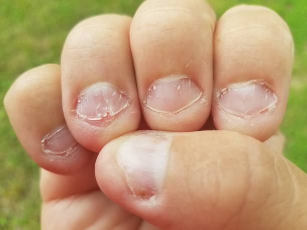 bitten fingernails stock photo