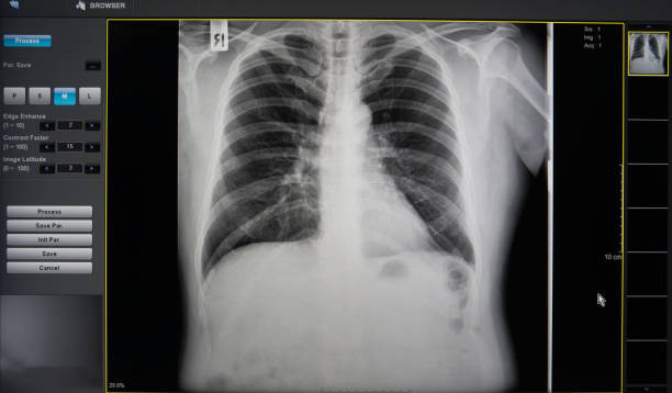 Best Broken Rib X Ray Stock Photos, Pictures & Royalty-Free Images - iStock