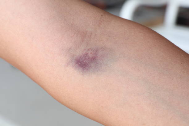 Age bruises old Easy bruising: