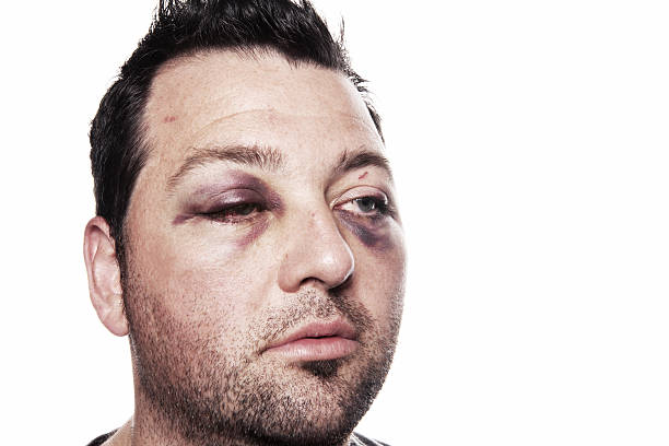 black eye injury accident violence isolated eye injury, male with black eye isolated on white. man after accident or fight with bruise black eye stock pictures, royalty-free photos & images