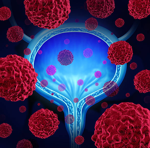 Bladder Cancer Bladder cancer medical concept as a urinary anatomical organ symbol with microscopic cancerous malignant cells spreading in the human body as a healthcare 3D illustration. biological cell photos stock pictures, royalty-free photos & images