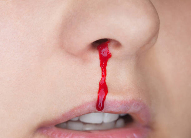 nose bleeding