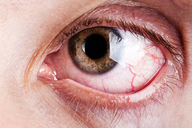Blood capillary human eye stock photo