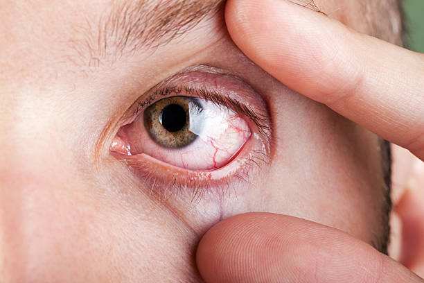 Blood capillary human eye stock photo