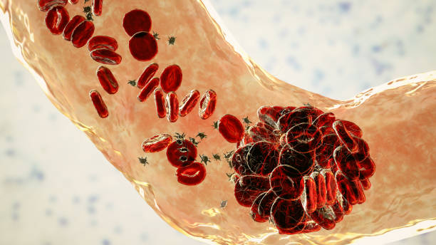 Blood clot made of red blood cells, platelets and fibrin protein strands stock photo