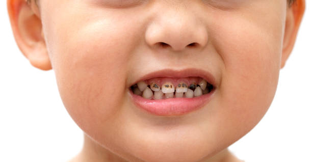 Boy showing tooth decay Tooth decay of children who like to eat sweets candy. And doesn't like brushing teeth rotten teeth in children stock pictures, royalty-free photos & images