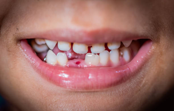 Boy with one missing teeth smile to show his missing teeth.  rotten teeth in children stock pictures, royalty-free photos & images