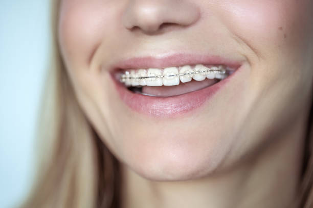 Braces, treatment for a crooked teeth Braces, treatment for a crooked teeth, closeup photo of a beautiful smile of a young woman with white clean teeth, aesthetic dentistry and dental care concept dental braces stock pictures, royalty-free photos & images