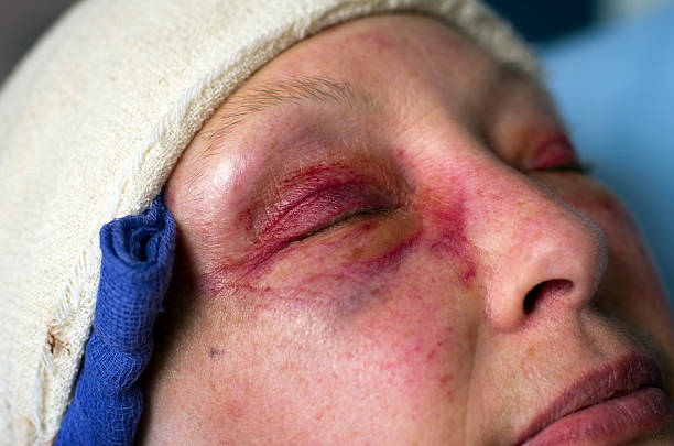 Brain surgery patient Severe bruising and swelling on a senior woman's face, two days after having a craniotomy and brain surgery to remove a tumour. It was a benign meningioma around the pituitary gland, had been growing for some years, and eventually made its presence felt with rapidly deteriorating vision in part of one eye leading to nausea and other unpleasant symptoms. The surgery involved an incision in the hair-line from above the left eyebrow, around the top of the forehead and down to just in front of the right ear. Burr holes were made in the skull and a section of the skull was then sawn out to provide access to the brain. The forehead was peeled back and the brain moved away to allow access to the area around the pituitary gland. The patient was on her feet next morning and made a good recovery apart from post-operative hypopituitarism and loss of senses of taste and smell. Moral - make sure you always have regular eye tests. Had the patient not done so, blindness and death would have resulted! black eye stock pictures, royalty-free photos & images