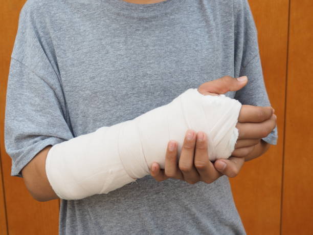 сломанная рука аварии врач положил на лечение руку - picture of a broken ar...