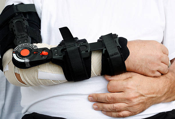 Gips arm gebrochen Arm gebrochen Gips arm gebrochen Ulnafraktur oder