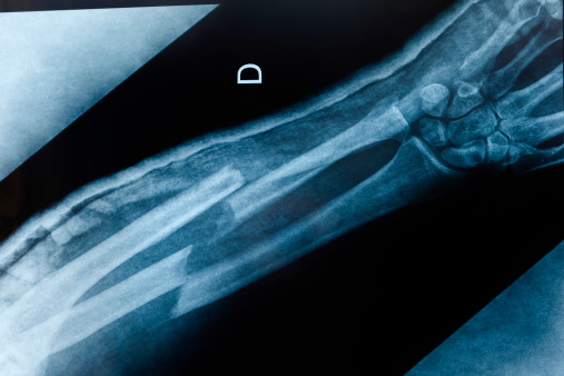 An x-ray image of an boken arm with double fracture: radius and ulna.