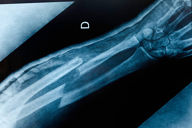 broken arm x-ray An x-ray image of an boken arm with double fracture: radius and ulna. bone fracture stock pictures, royalty-free photos & images