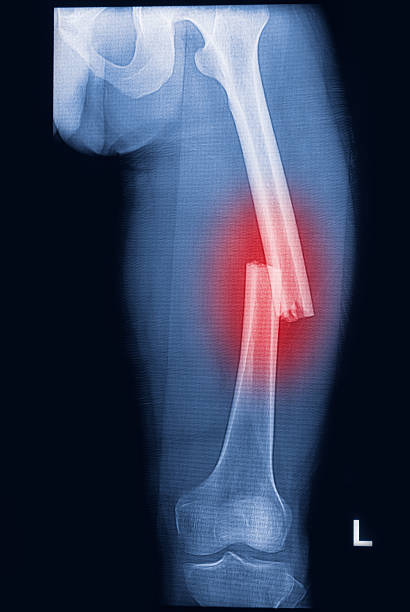 2,085 Broken Femur Stock Photos, Pictures & Royalty-Free Images - iStock