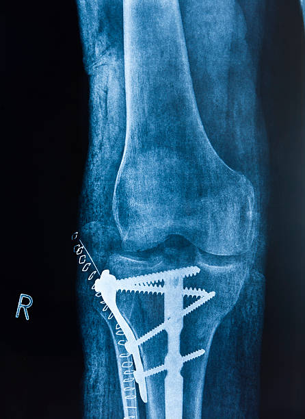 Broken leg X-ray image of a broken leg with osteosynthetic material.Please see some similar pictures from my lightbox: x ray plates stock pictures, royalty-free photos & images