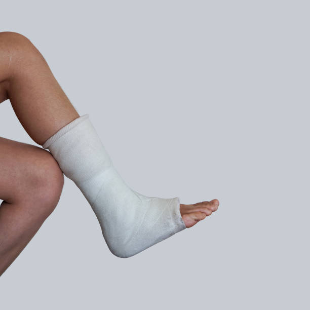 Broken leg with the cast rests on the knee of the other leg. stock photo
