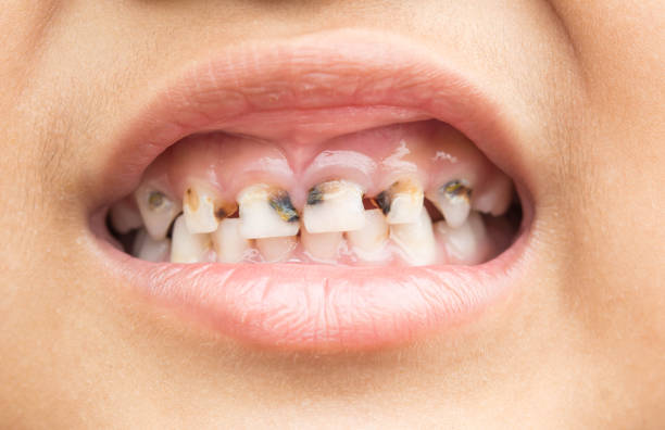 Broken teeth in children  rotten teeth in children stock pictures, royalty-free photos & images