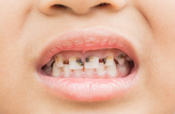Broken teeth in children  rotten teeth in children stock pictures, royalty-free photos & images