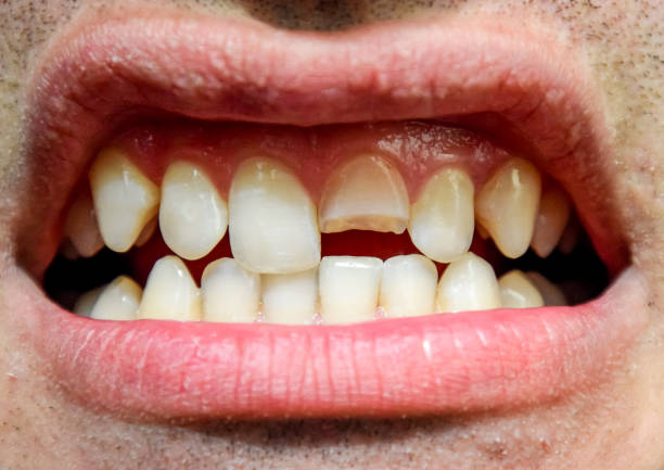 Broken tooth. Broken upper incisor in a man mouth. Broken tooth. Broken upper incisor in a man mouth. Man shows oral cavity to the dentist. Treatment of a broken tooth. bone fracture stock pictures, royalty-free photos & images