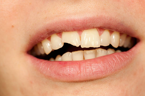 3,983 Broken Tooth Stock Photos, Pictures & Royalty-Free Images - iStock