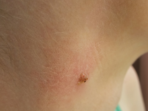papilloma on the neck baza anthelminticelor