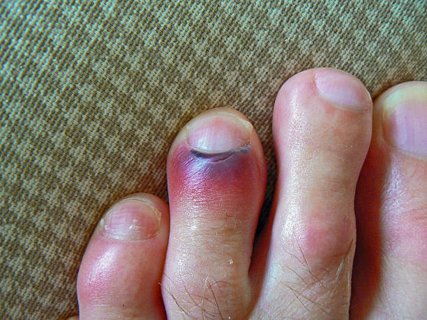 Bruised toe stock photo